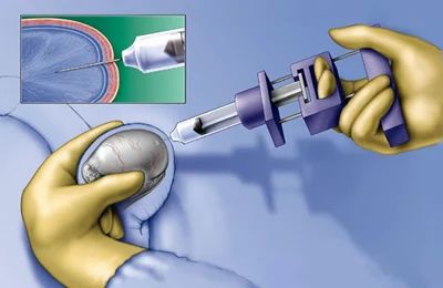 Surgical Sperm Retrieval