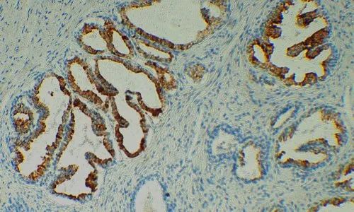Anti-PSA test kit, HISTOPATHOLOGY