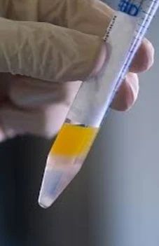 Afb Semen Test