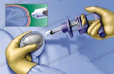 Surgical Sperm Retrieval