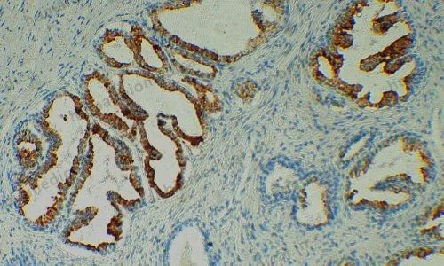 Anti-PSA test kit, HISTOPATHOLOGY
