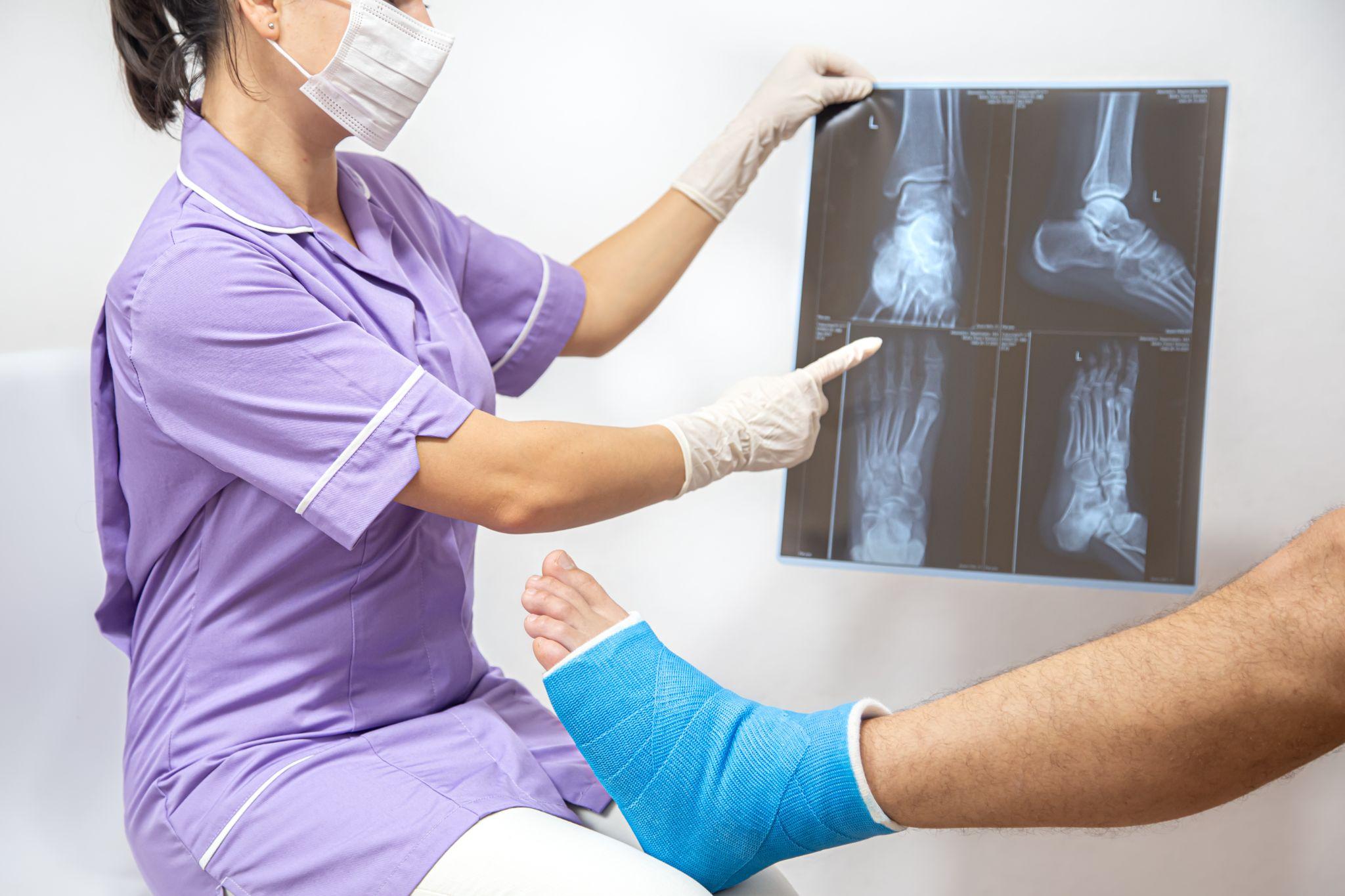 A doctor showing a Fracture X-Ray.