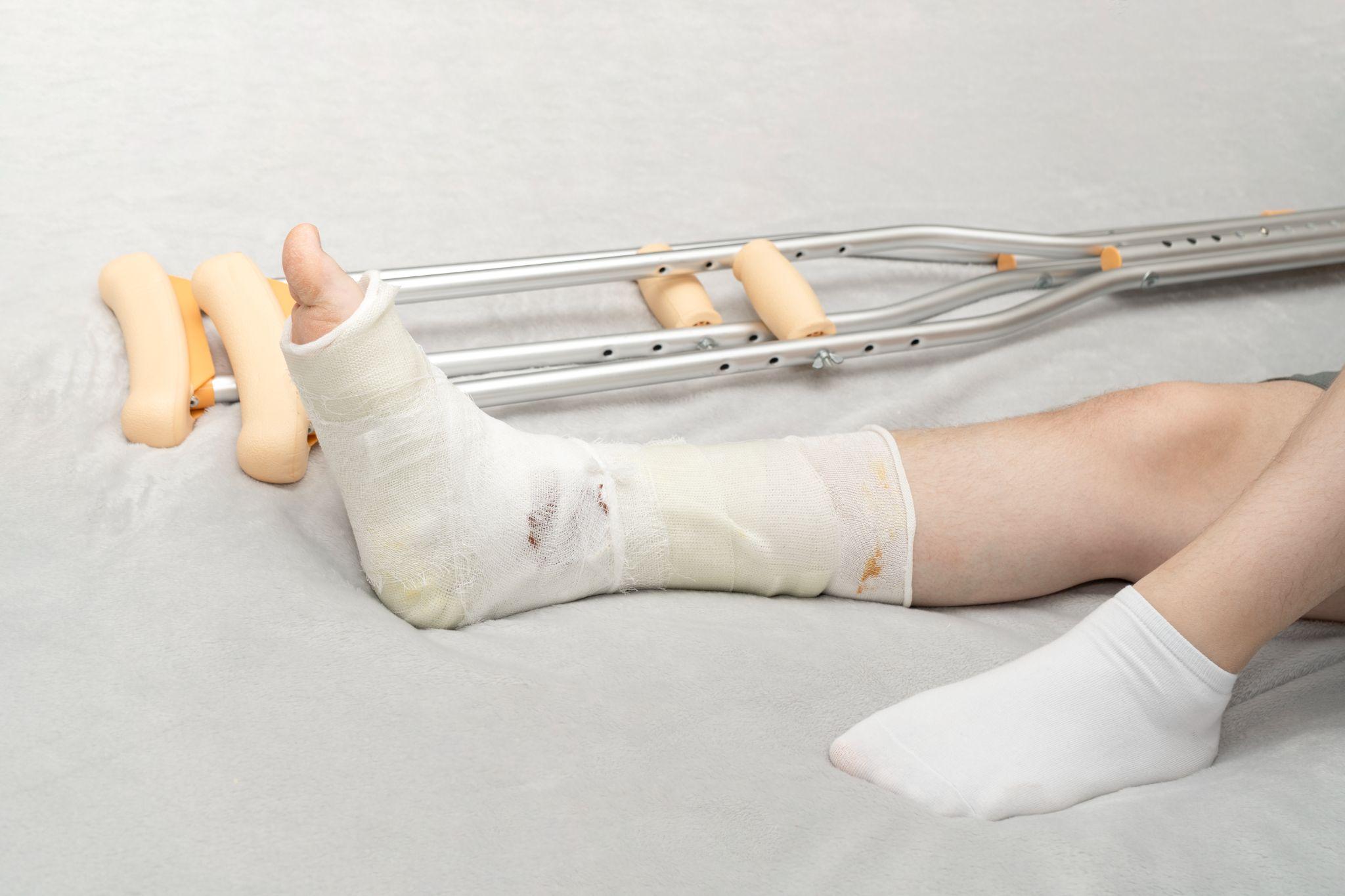 A fractured leg