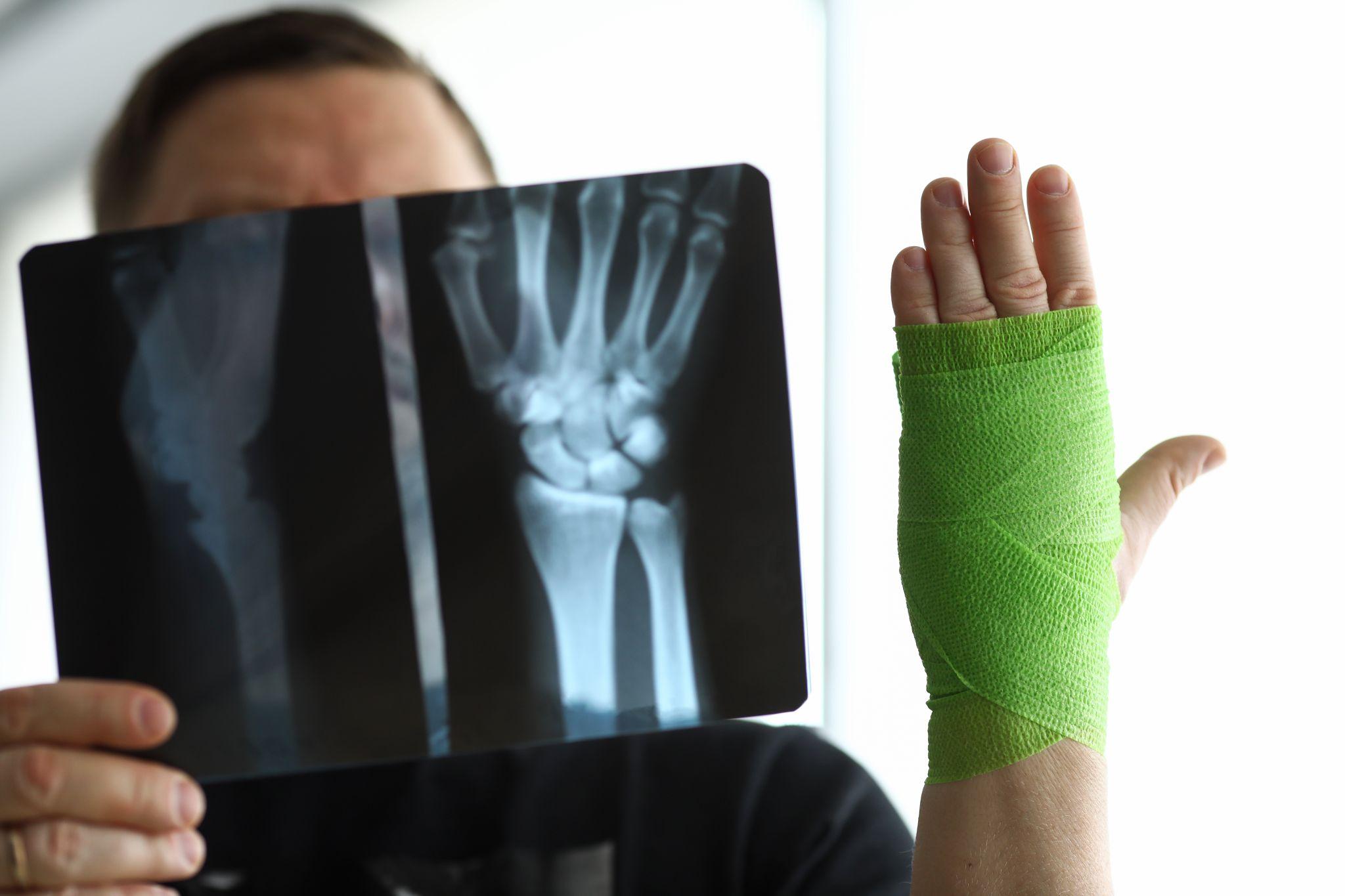 A man with a bone fracture x-ray.