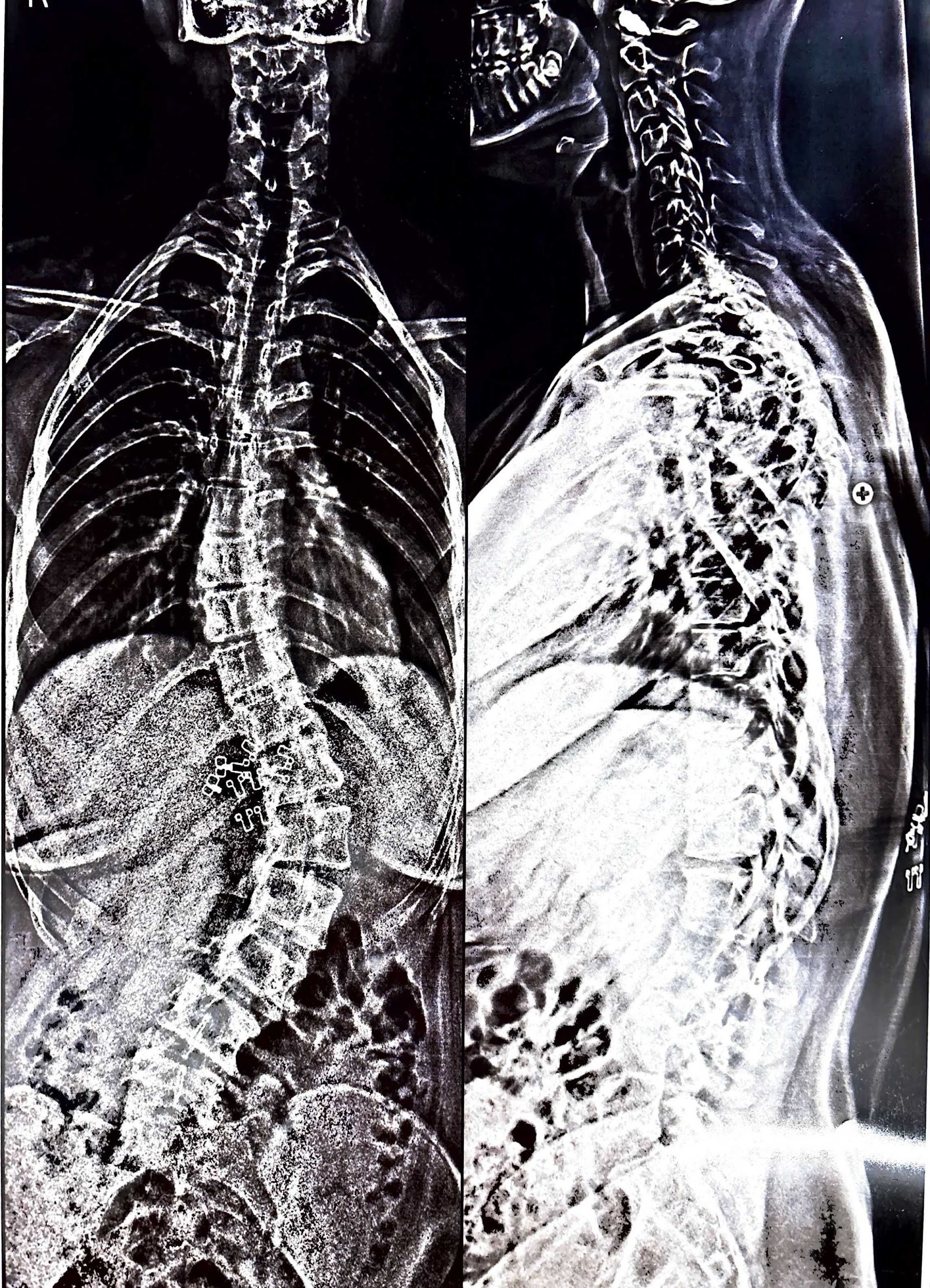 स्कोलियोसिस क्या है, इसके कारण, दर्द और उपचार (Scoliosis Meaning in Hindi)
