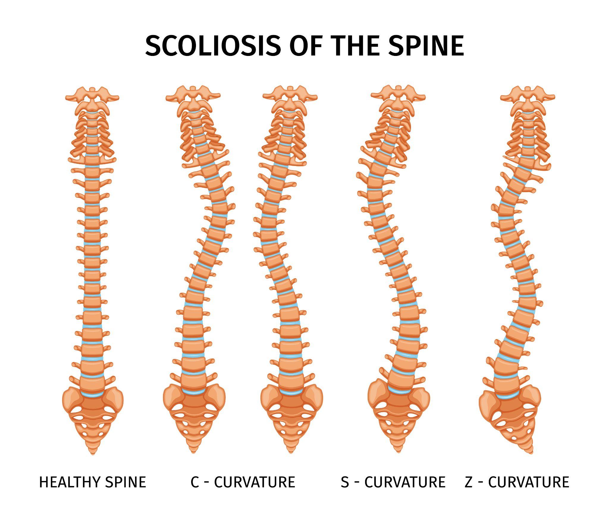 This medical infographic illustrates a healthy spine alongside different scoliosis patterns, including C-shaped, S-shaped, and Z-shaped curvatures. It visually explains how the spine deviates from its normal alignment in scoliosis.