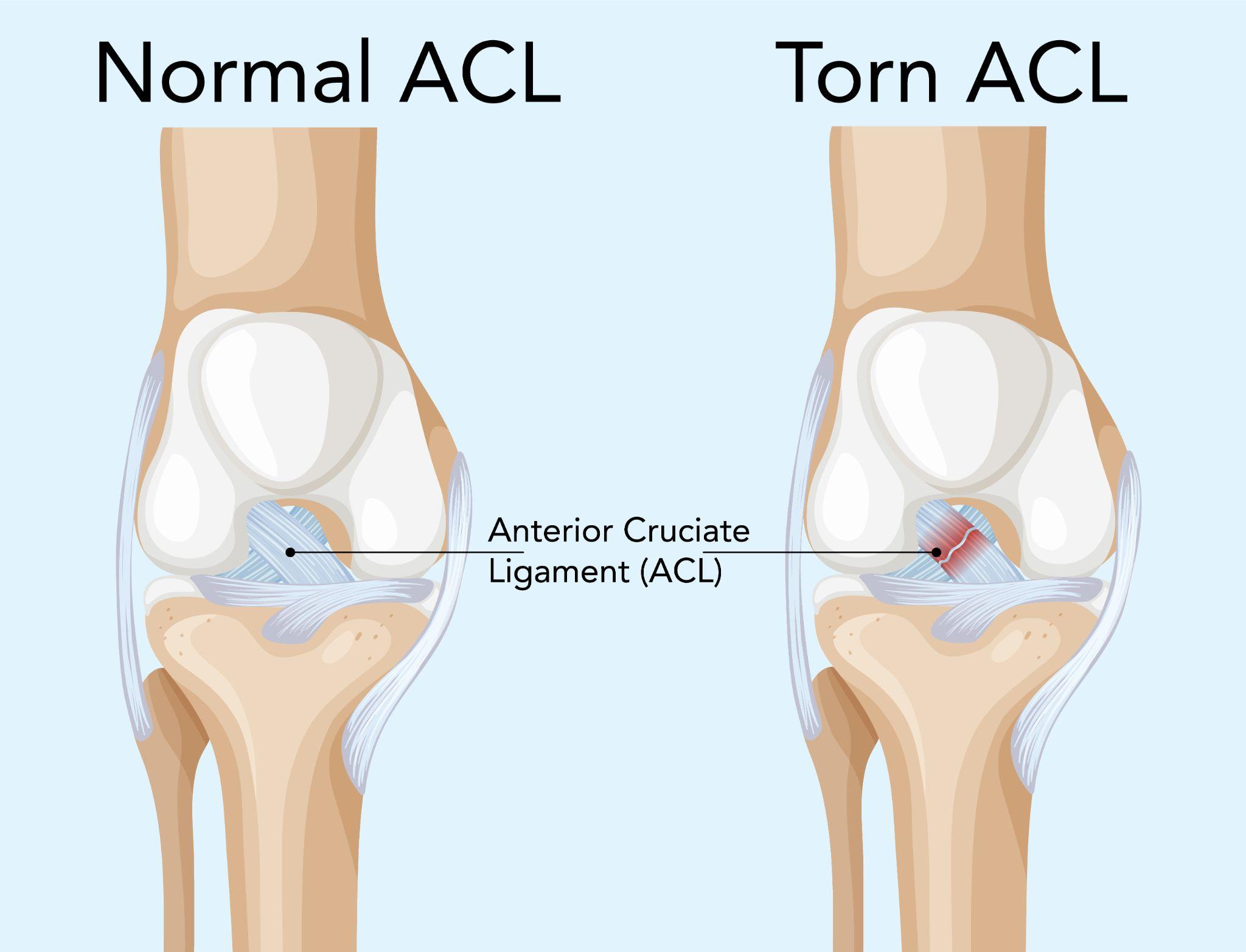 ACL क्या है? कारण, लक्षण, इलाज और रिकवरी की पूरी जानकारी