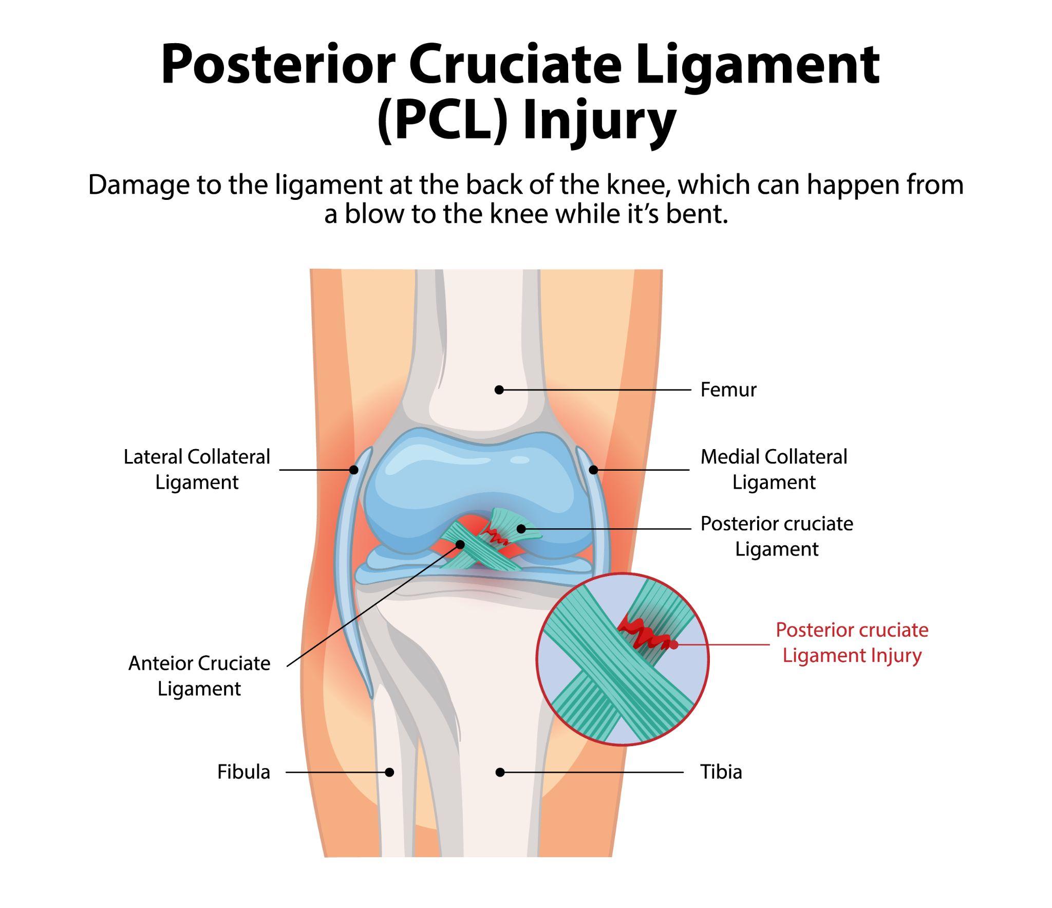 PCL क्या है? घुटने की इस चोट को समझें आसान भाषा में