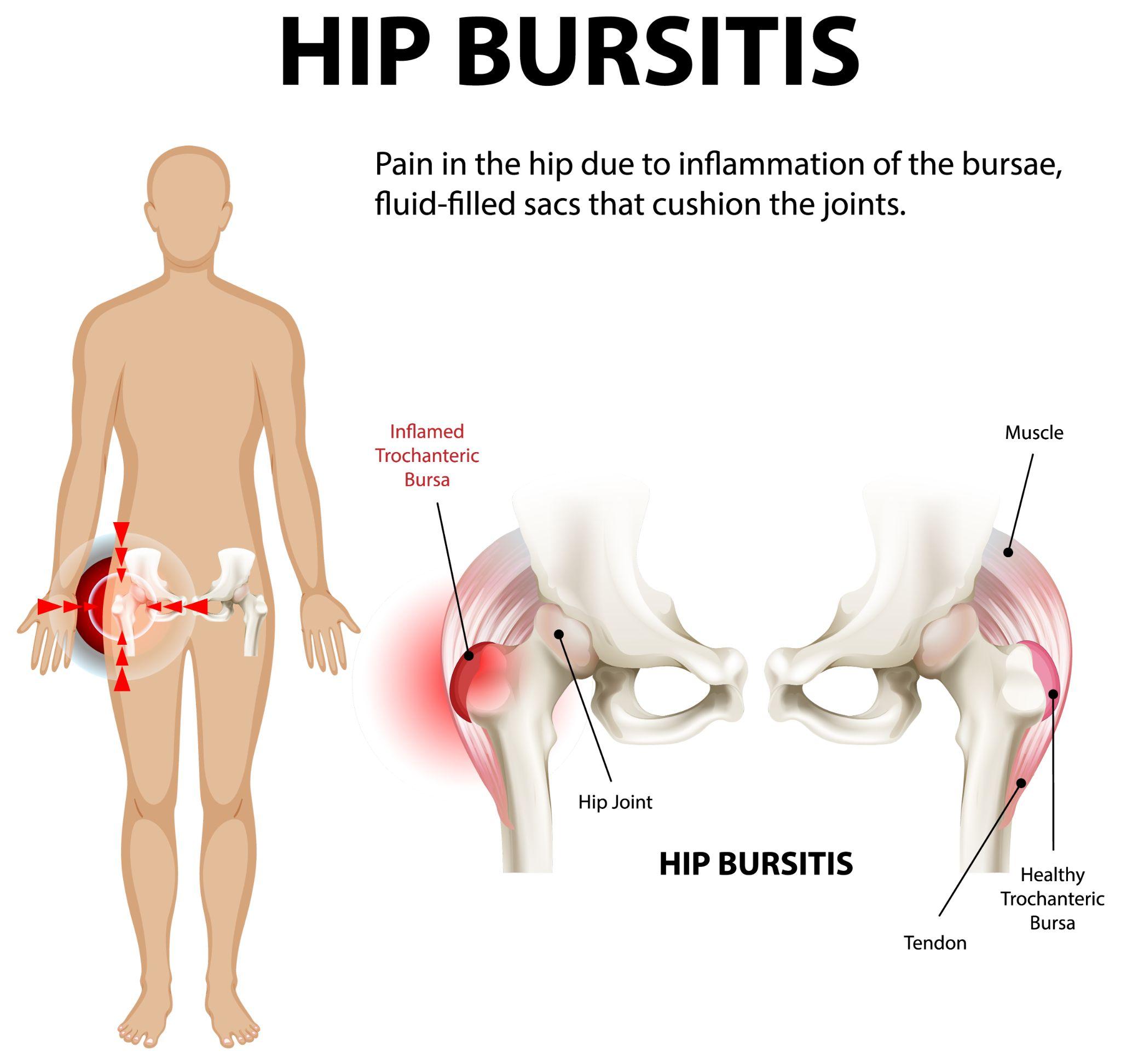 Diagram illustrating hip bursitis and inflammation around the hip joint.