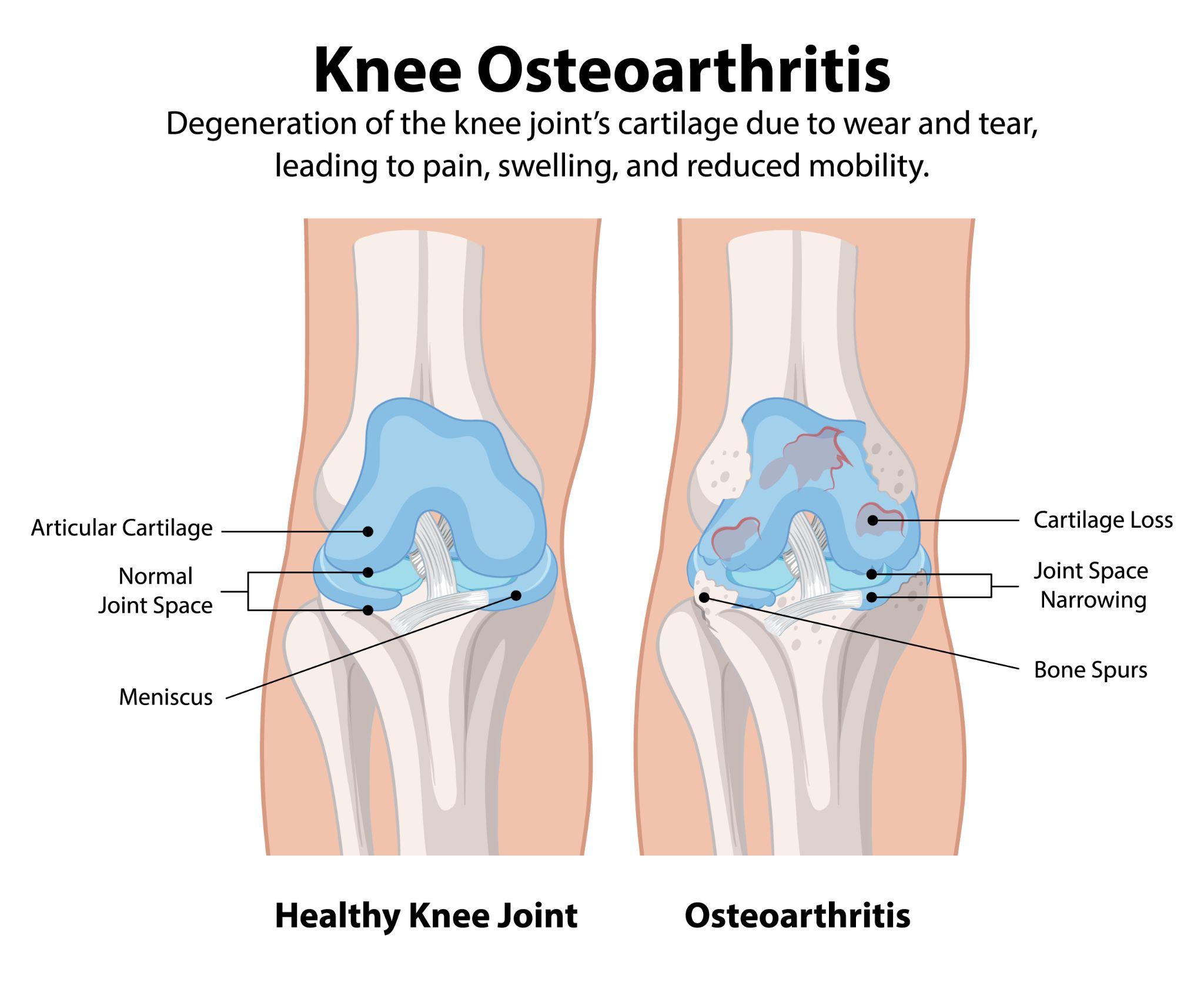 Medical illustration comparing a healthy knee joint with knee osteoarthritis, highlighting cartilage degeneration and bone spurs.