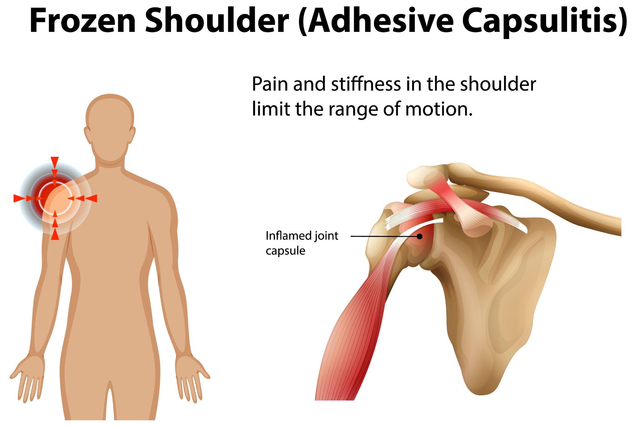 A 3D medical illustration showing inflammation and pain in the shoulder joint, commonly associated with adhesive capsulitis.