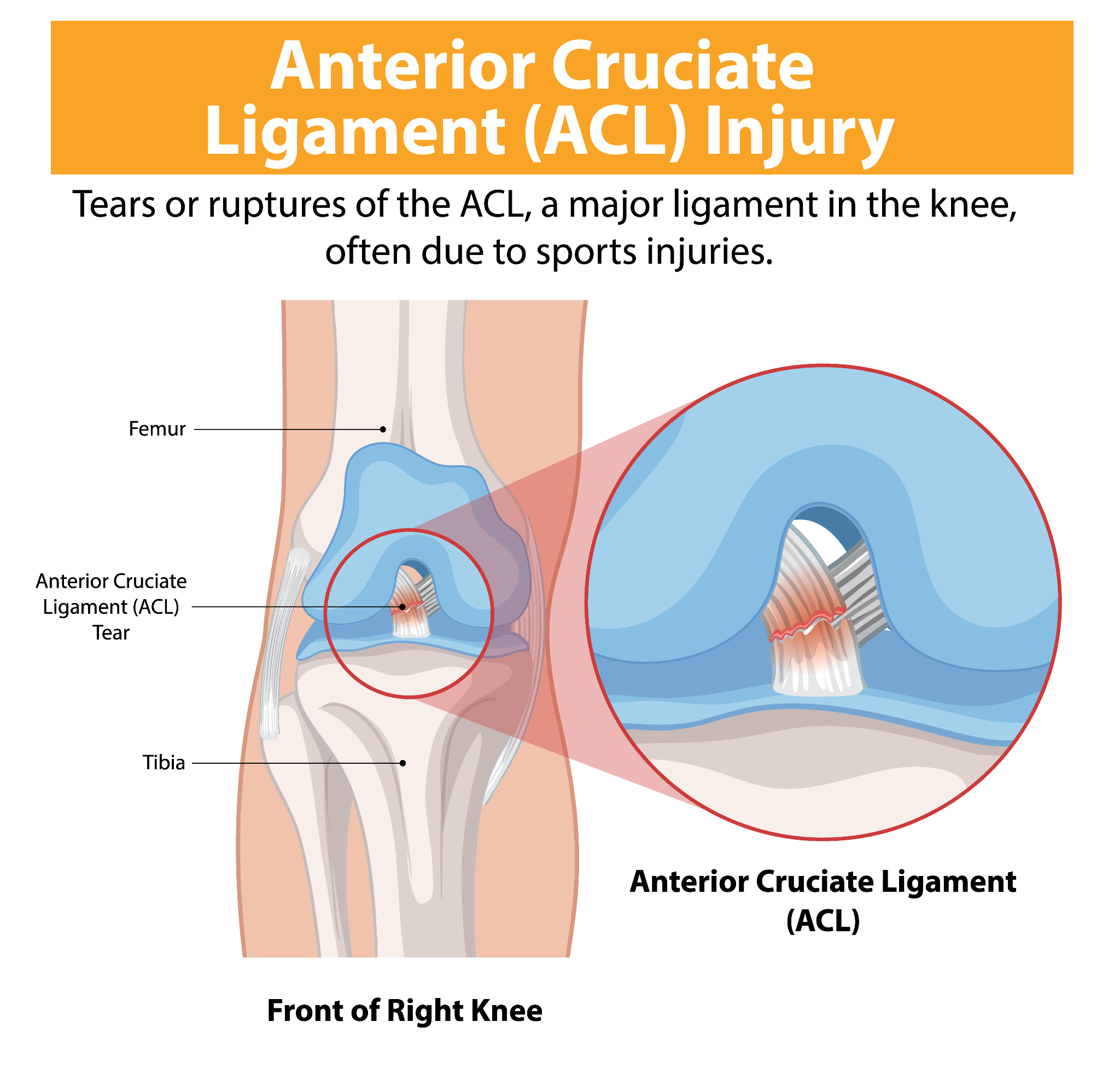 Medical infographic showing the structure of the knee and the location of the anterior cruciate ligament, clearly illustrating how an ACL tear affects stability and movement.