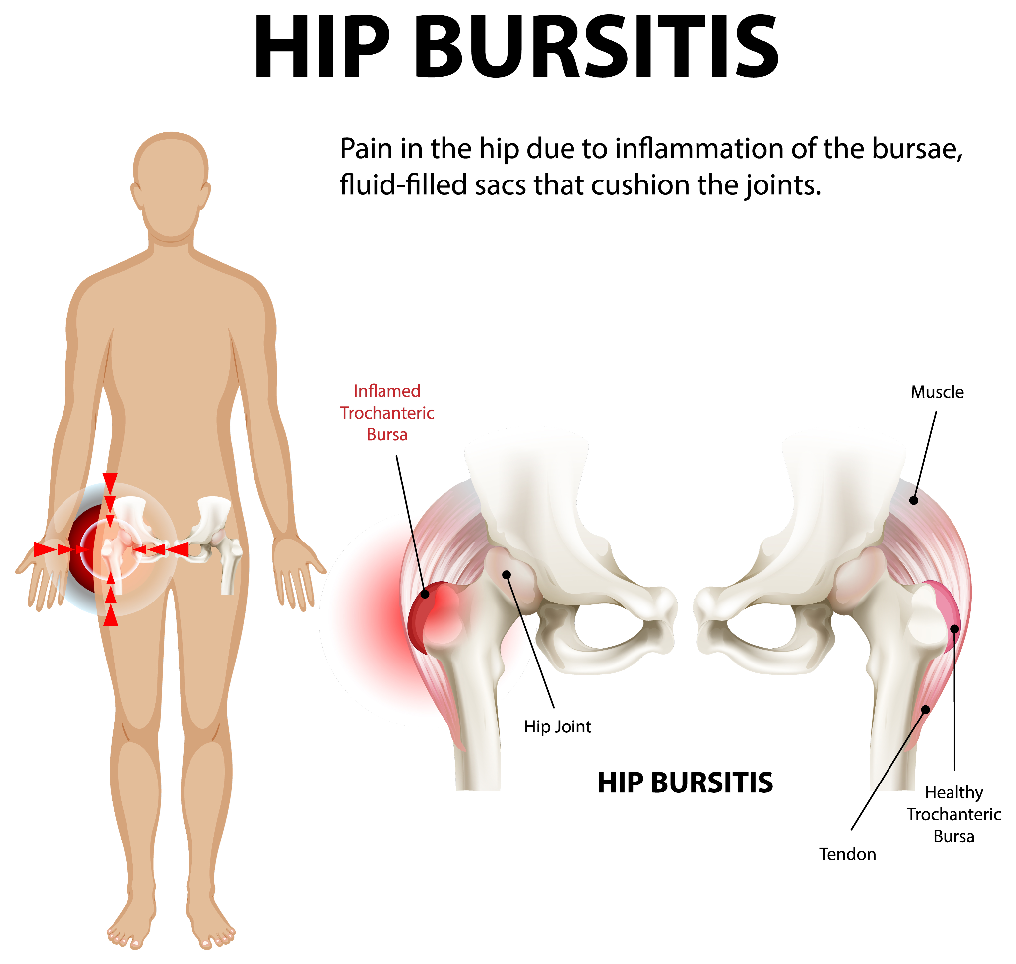 An infographic illustrating hip bursitis, showing the inflamed bursa around the hip joint.