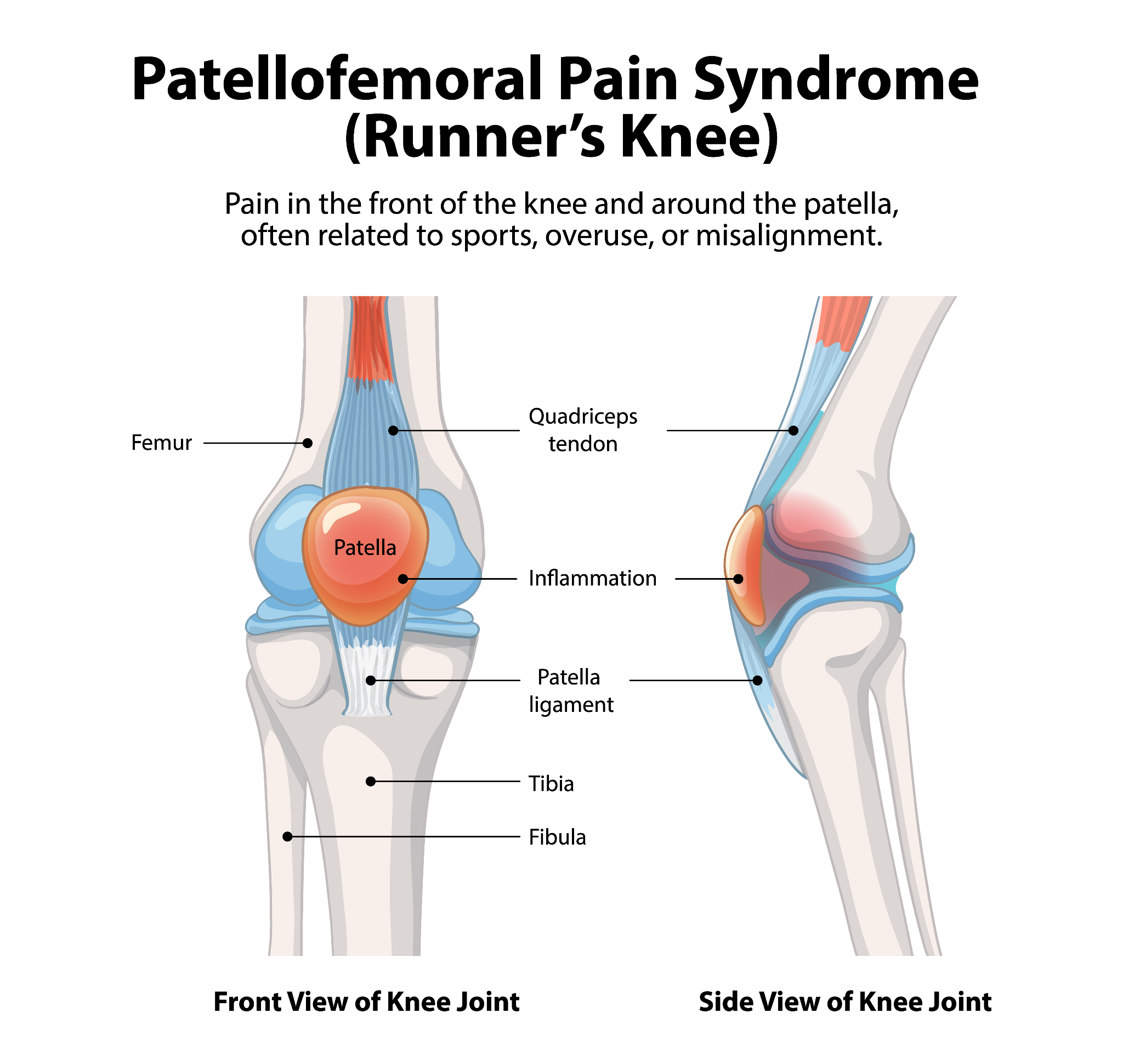 An infographic illustrating runner’s knee (patellofemoral pain syndrome), showing the kneecap, irritated cartilage, and misalignment issues.