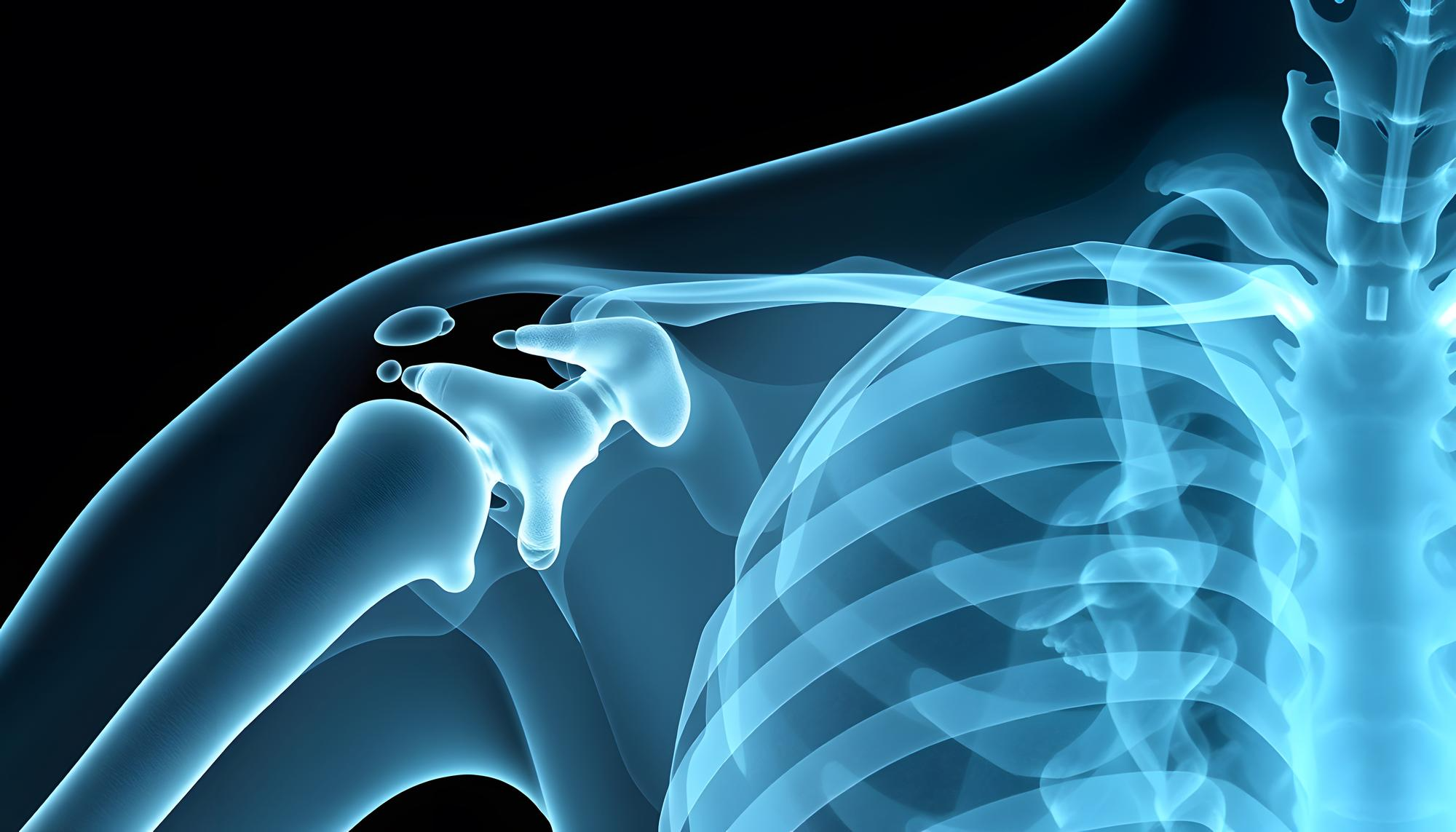 X-ray image showing the shoulder joint, including the humeral head and socket, typically used by doctors to assess joint structure.