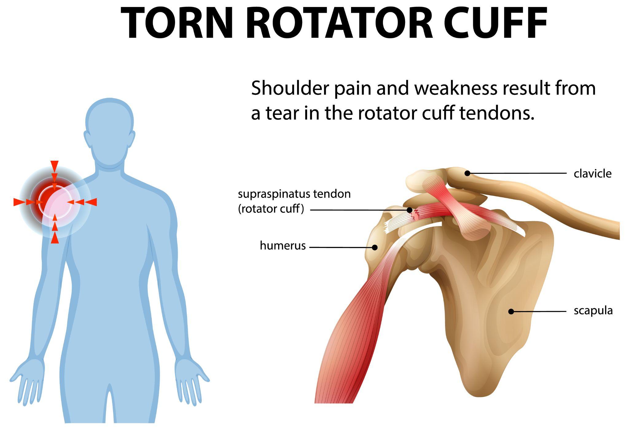 Medical illustration explaining torn rotator cuff and shoulder joint anatomy.