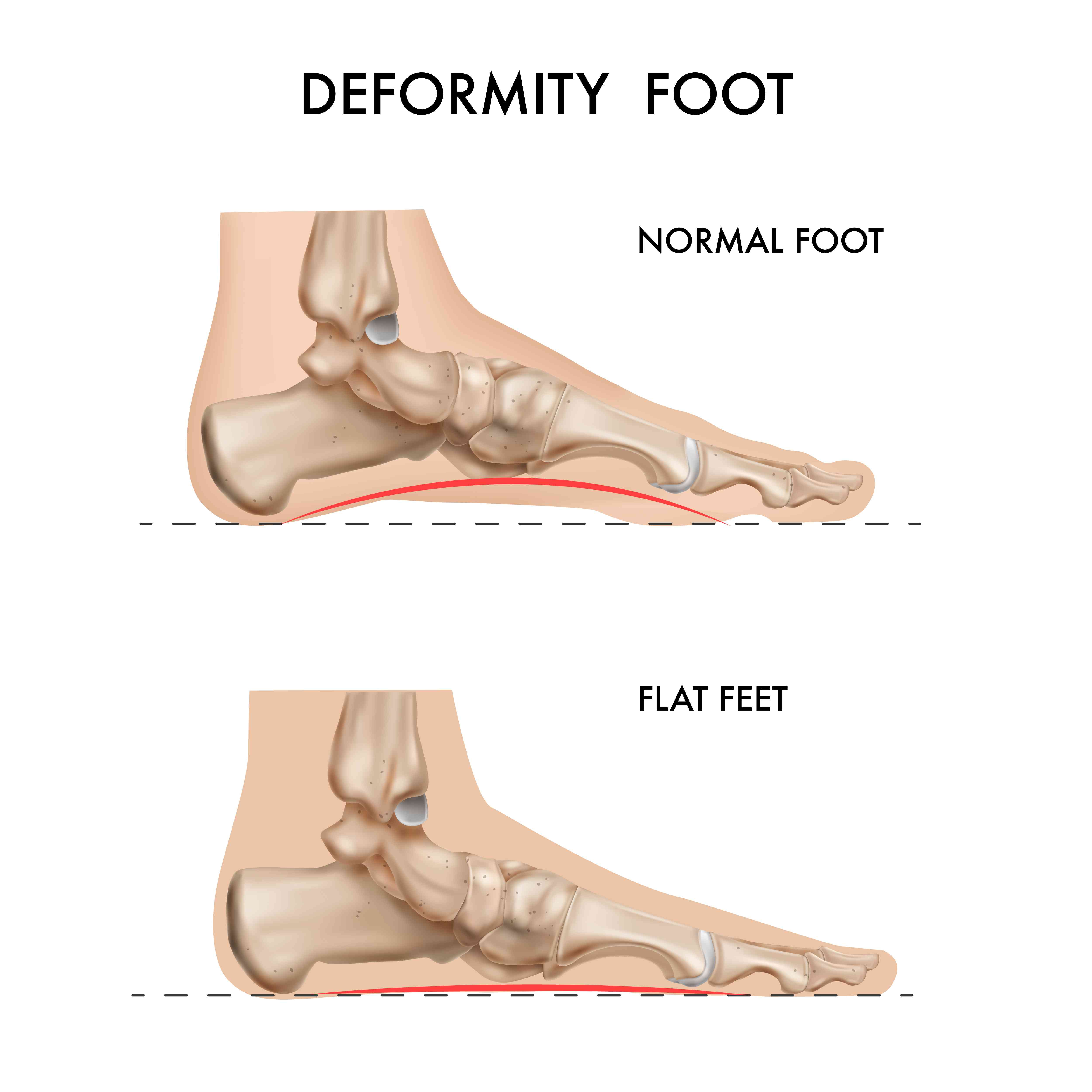 Are Flat Feet Causing You More Problems Than You Think?