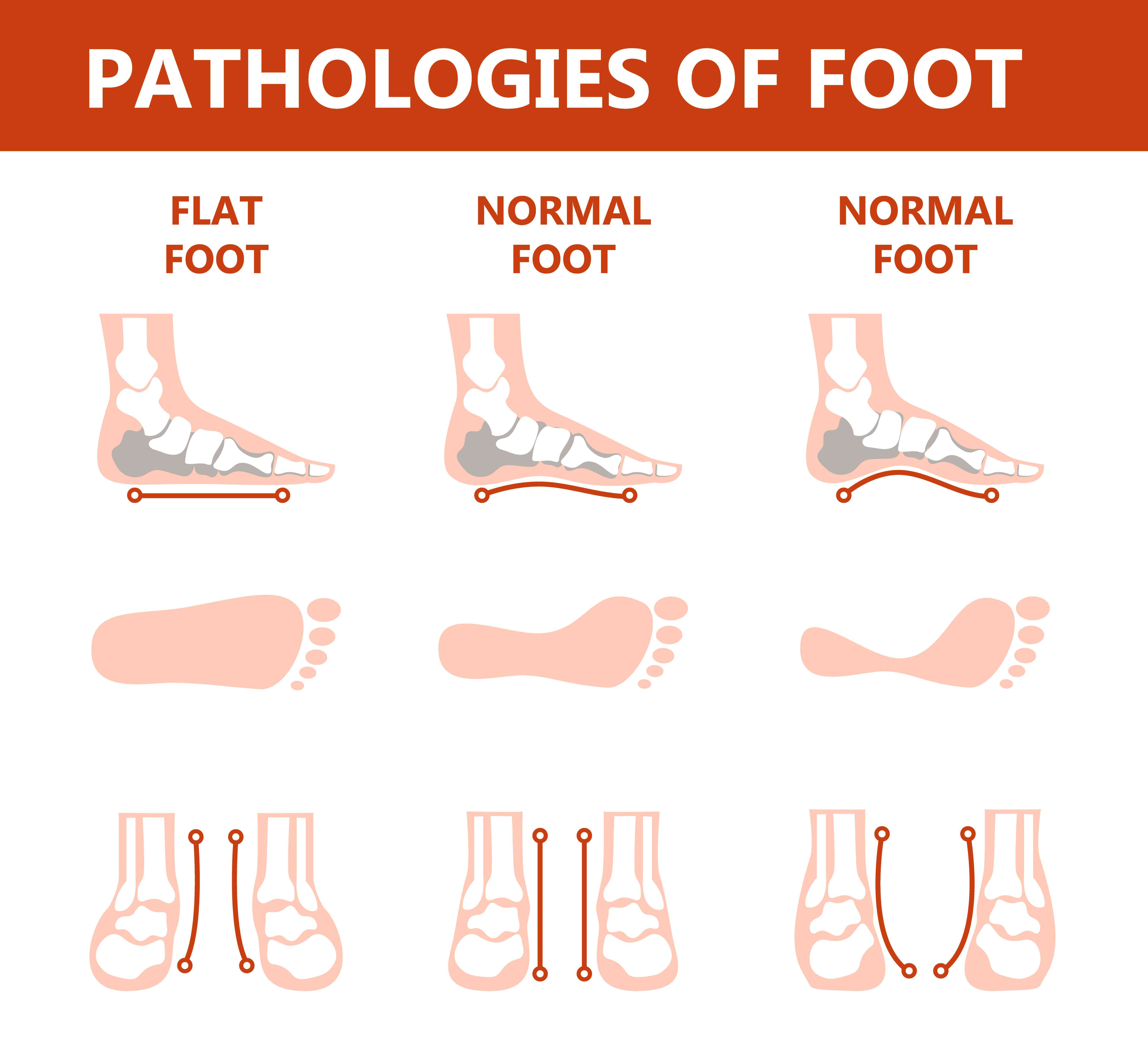 Diagram comparing flat foot and normal foot anatomy, showing arch differences, foot impressions, and bone alignment.