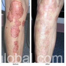 www.rentingglobal.com, renting, global, Una, Himachal Pradesh 174303, India, AROGYAM PURE HERBS KIT FOR PSORIASIS