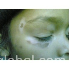 www.rentingglobal.com, renting, global, Una, Himachal Pradesh 174303, India, AROGYAM PURE HERBS KIT FOR VITILIGO