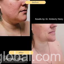 www.rentingglobal.com, renting, global, San Francisco, CA, USA, Best Breast Augmentation Campbell