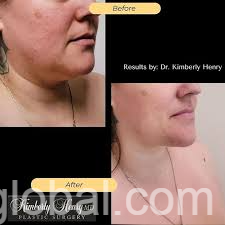 www.rentingglobal.com, renting, global, 350 Bon Air Rd suite 1, Greenbrae, CA 94904, USA, Boob Enlargement Redwood City