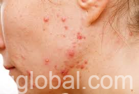 www.rentingglobal.com, renting, global, Dar es Salaam, Tanzania, acne,hormone,acne and hormone, Acne and hormone
