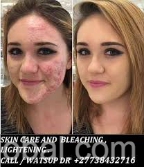 www.rentingglobal.com, renting, global, South Africa, healthy,beauty,skin,services, BEST SKIN WHITENING AND BLEACHING  PRODUCTS CALL  +27738432716