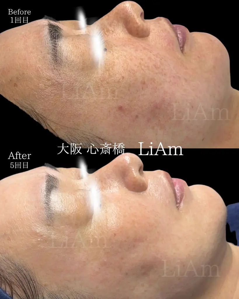肌質改善/小顔矯正/脂肪溶解/毛穴洗浄～LiAm(リアム)