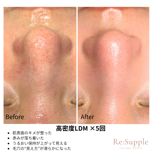 Re:Supple リサプリ|南青山　インディバ