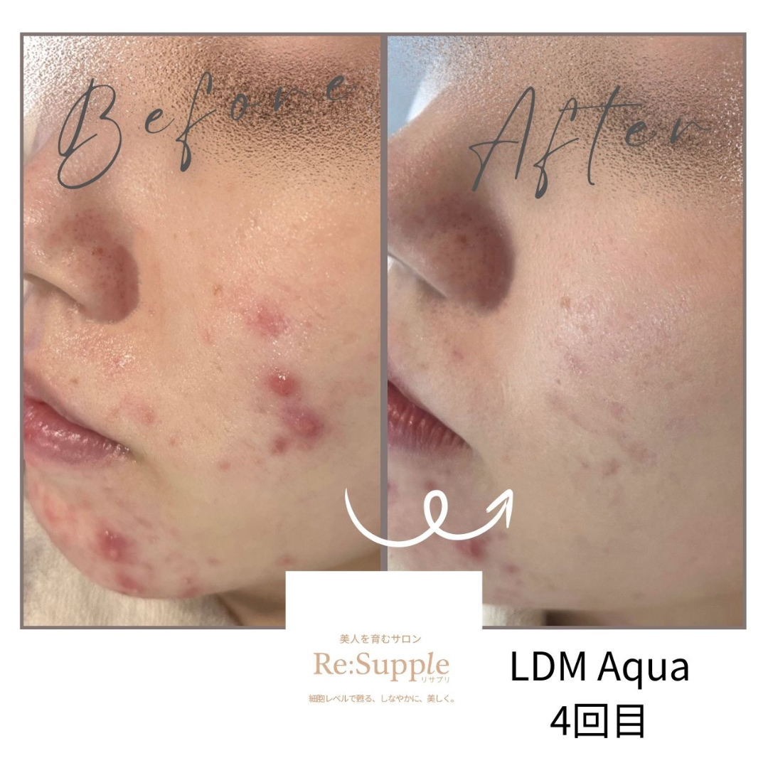 Re:Supple リサプリ|南青山　インディバ
