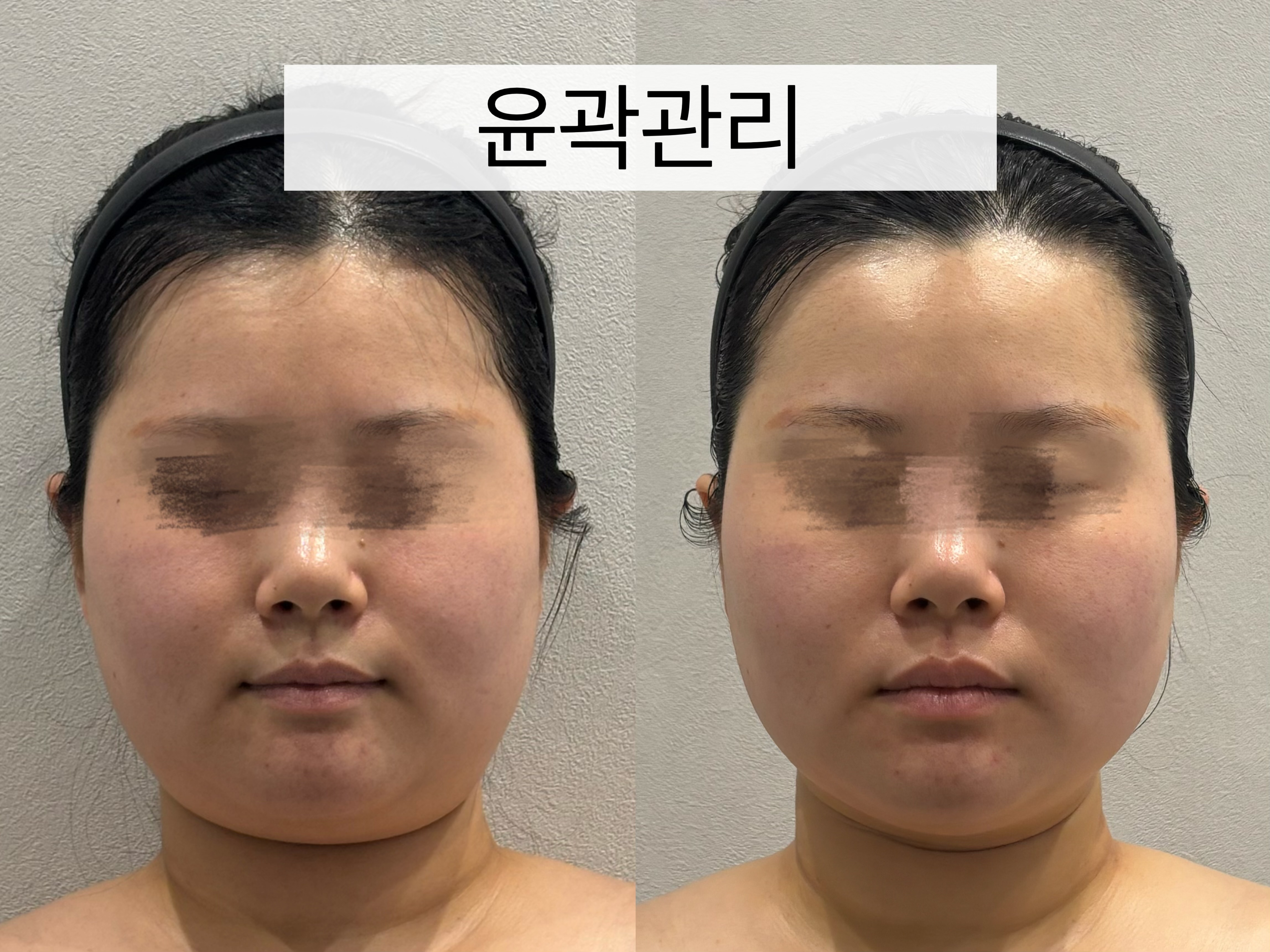 OUV에스테틱 이미지