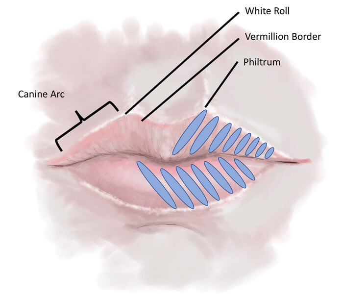 Restylane Kysse Lidocaine - Image 2