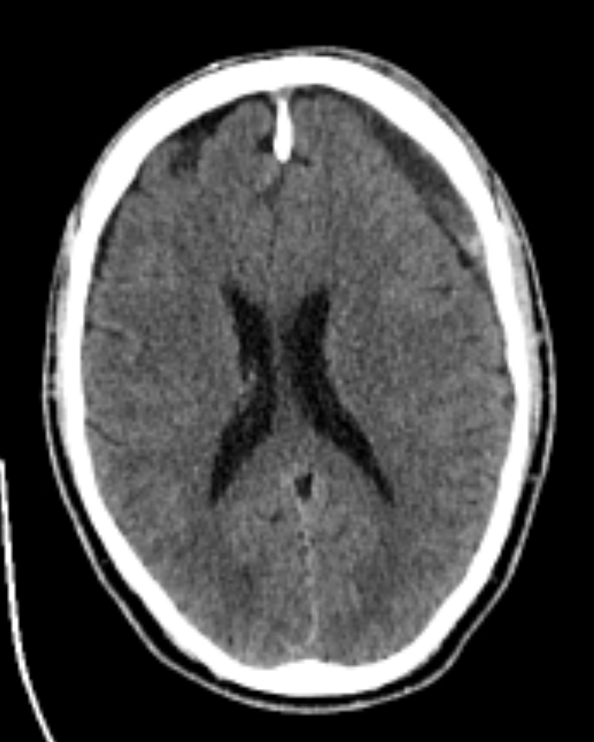 Craniotomia — controle pós-operatório TC