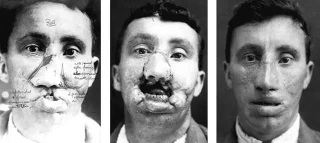 these-are-some-of-the-examples-of-before-and-after-facial-v0-telzdmgl6tmf1