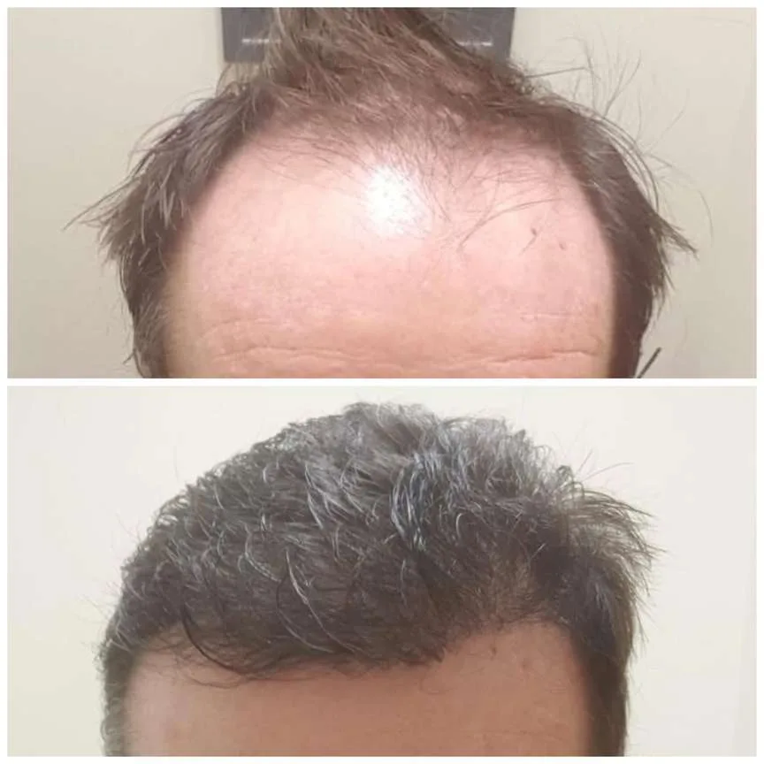 Patient before and after result