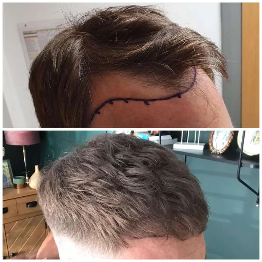 Patient before and after result