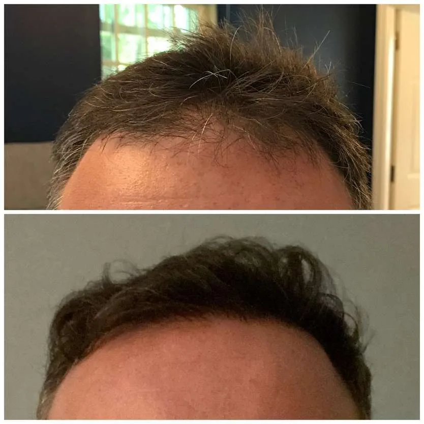 Patient before and after result