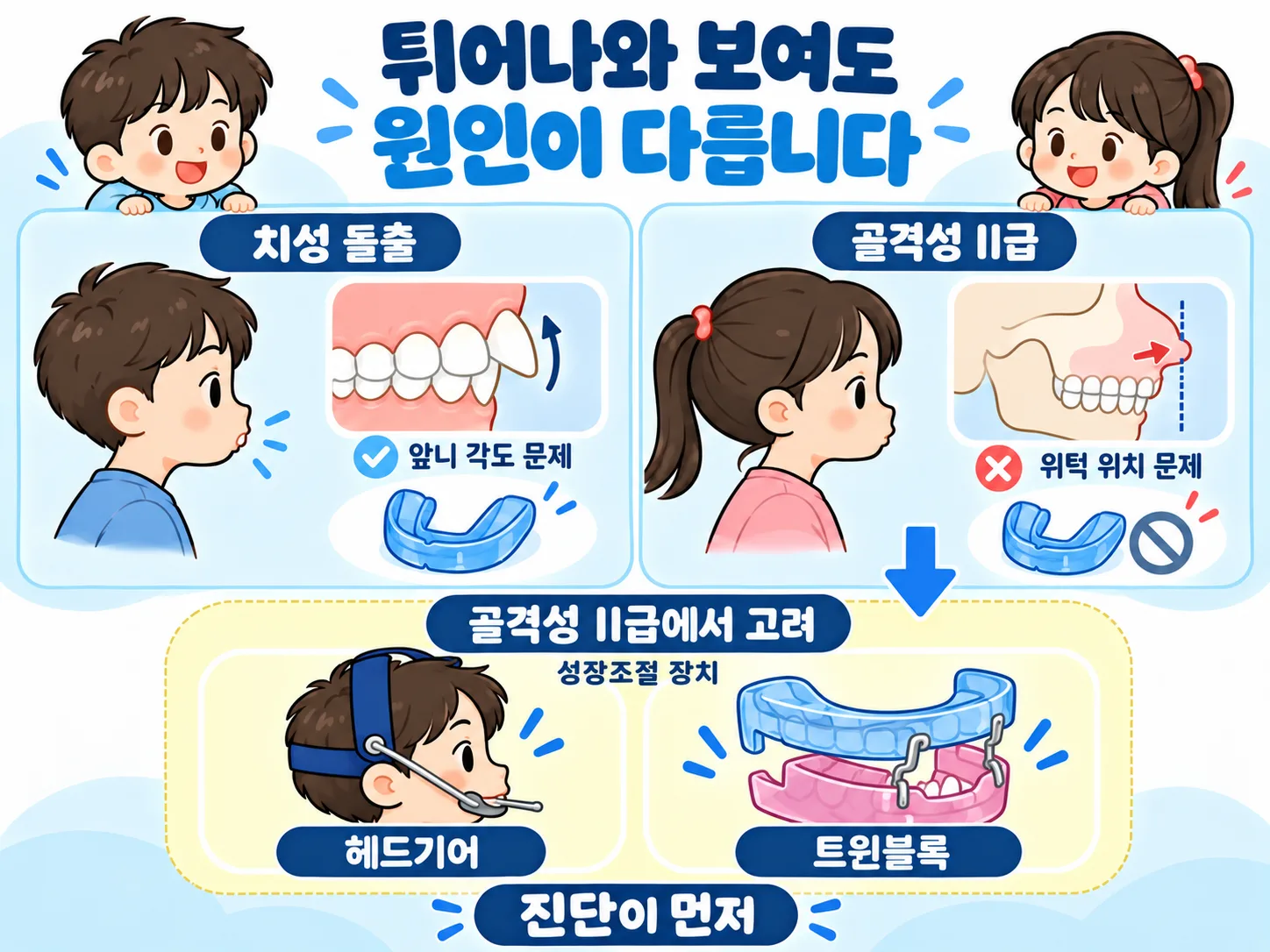 치성 돌출과 골격성 II급 비교 인포그래픽