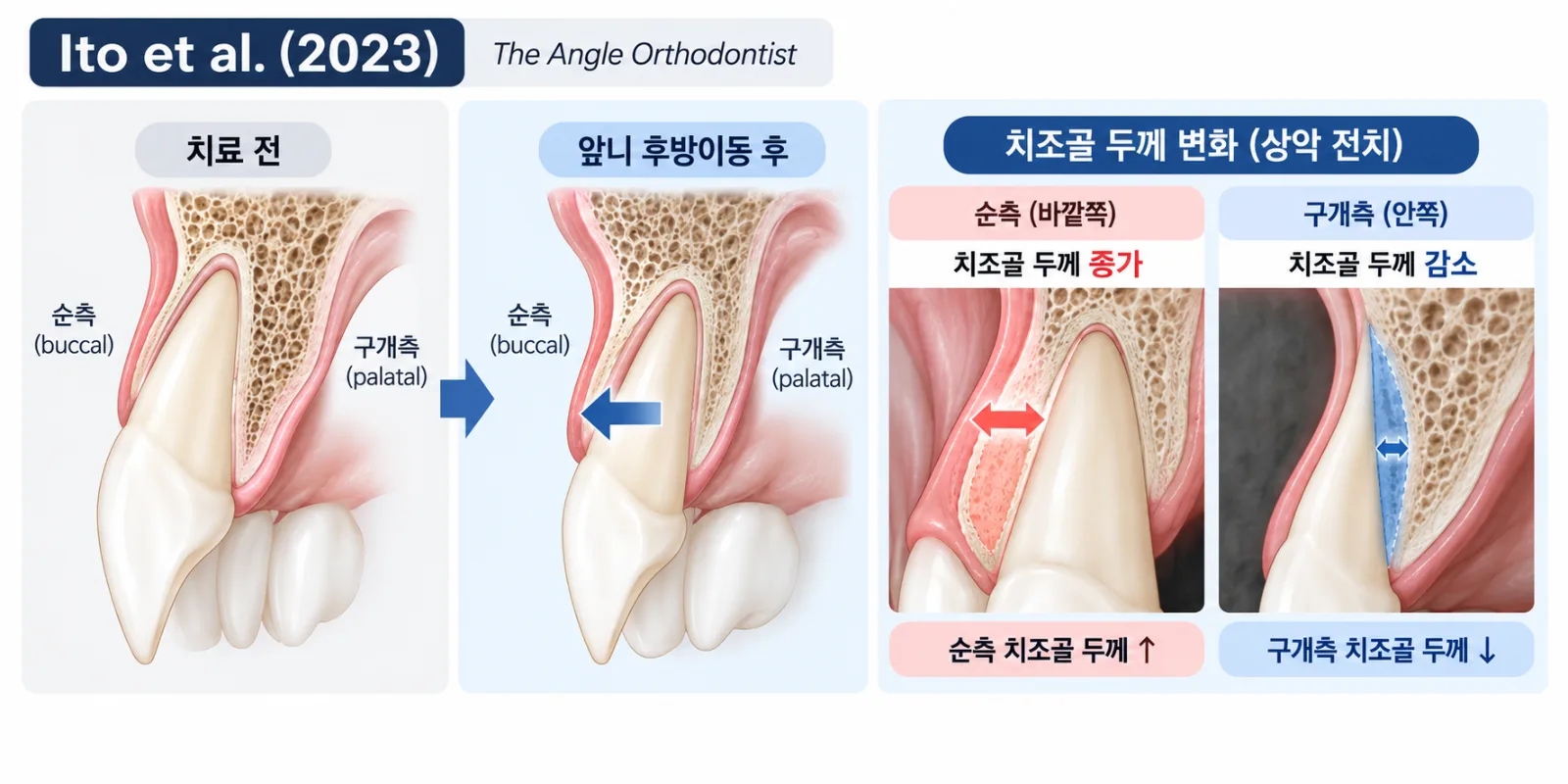 상악 전치 후방이동과 치조골 두께 변화