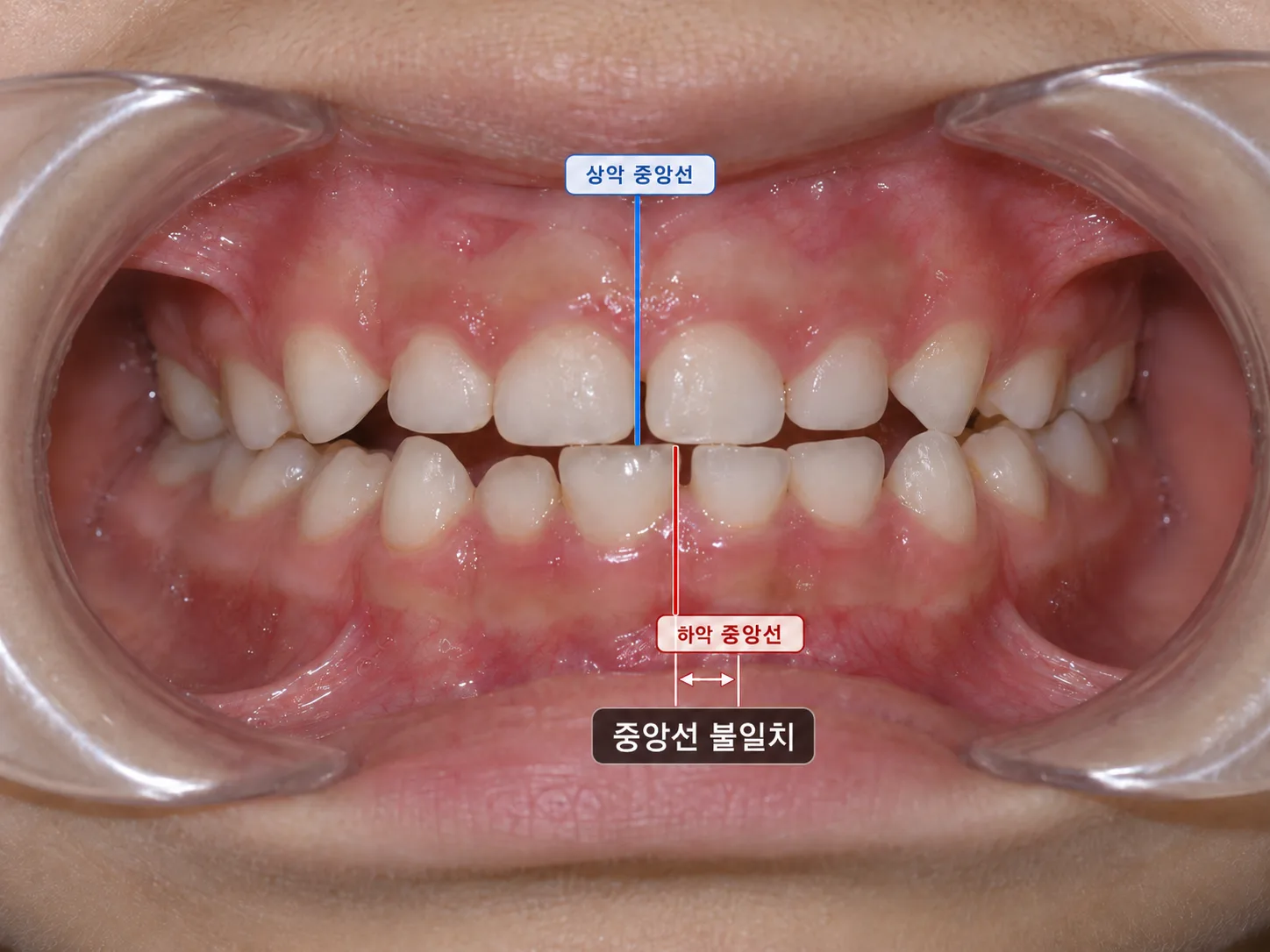 치아 중앙선 불일치 임상 사진