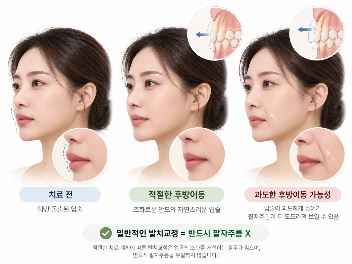 발치교정과 팔자주름 변화 안내