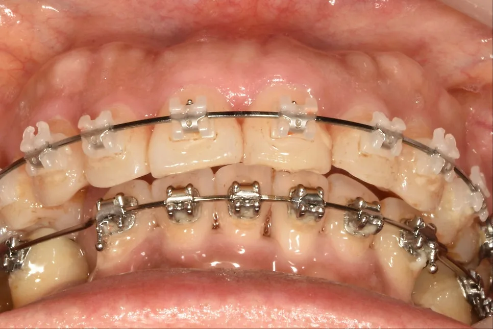 05 sleepapnea 37