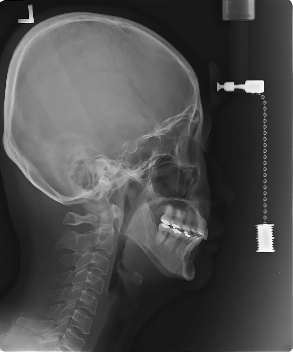 05 sleepapnea 84