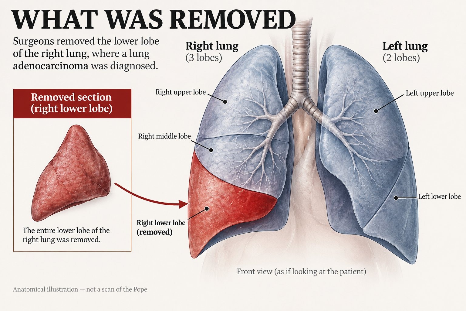 Pope Leo XIV, whose Vatican audiences have been cancelled until 20 October, was diagnosed with lung adenocarcinoma after surgeons removed the lower lobe of his right lung, with doctors reporting an excellent prognosis…