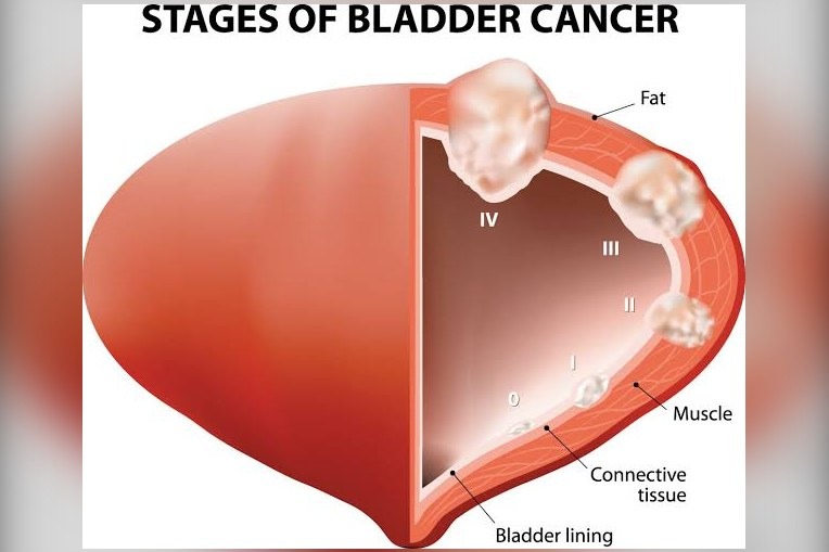University of Edinburgh researchers studied more than 11,700 leiomyosarcoma patients, finding urinary tract tumours among those linked to the lowest survival rates.