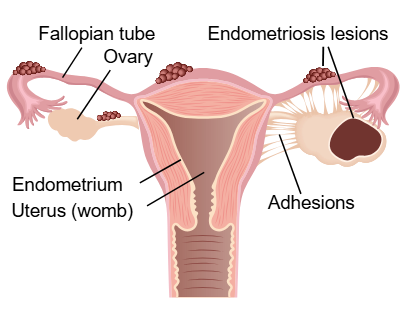 New £2.3m Scottish trial gives hope to millions of endometriosis sufferers whose pain cannot be controlled by surgery