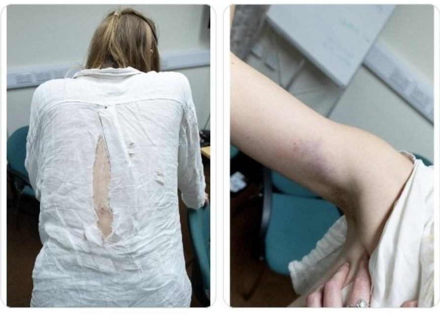 Injuries sustained by a Reform UK conference heckler, after audience members grabbed a protester's face, pulled her hair and struck her with a walking stick as activists were ejected from Nigel Farage's speech.