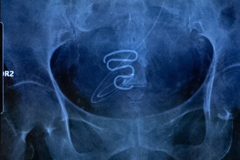 Between 1966 and 1970, Danish doctors inserted IUDs into approximately 4,500 Greenlandic women and girls without consent — the youngest just 13 — prompting a compensation law awarding £34,404 to each woman harmed.