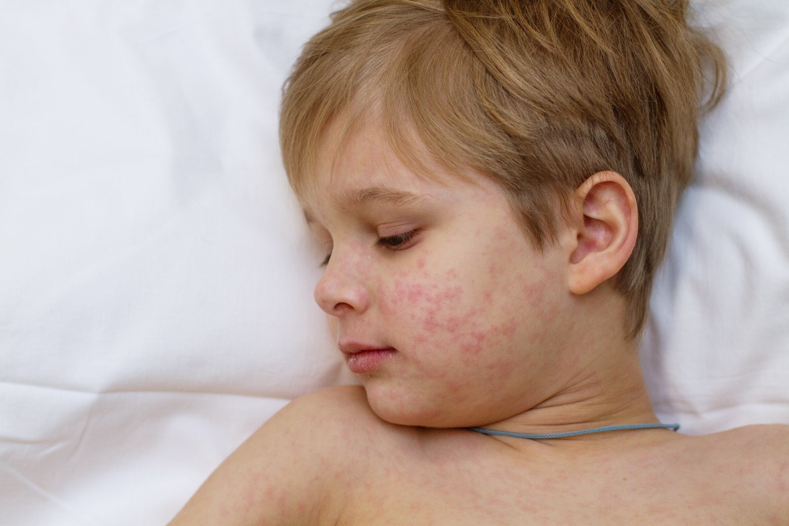 An unvaccinated traveller arrived in Los Angeles from Chicago on 12 September, triggering a measles exposure alert spanning six California counties and extending to Colorado.